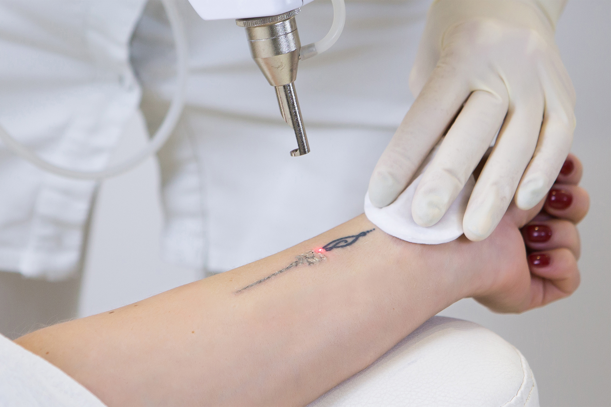 Cosmetic Tattoo Removal, Semi-Permanent Makeup Removal